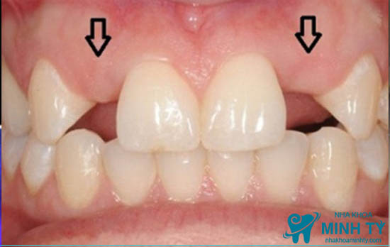Nên lựa chọn phương pháp cấy ghép IMPLANT hay răng sứ bắc cầu cho răng bị mất